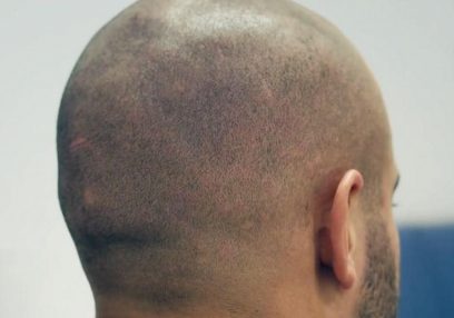 Bald Head Hair Tattoo
